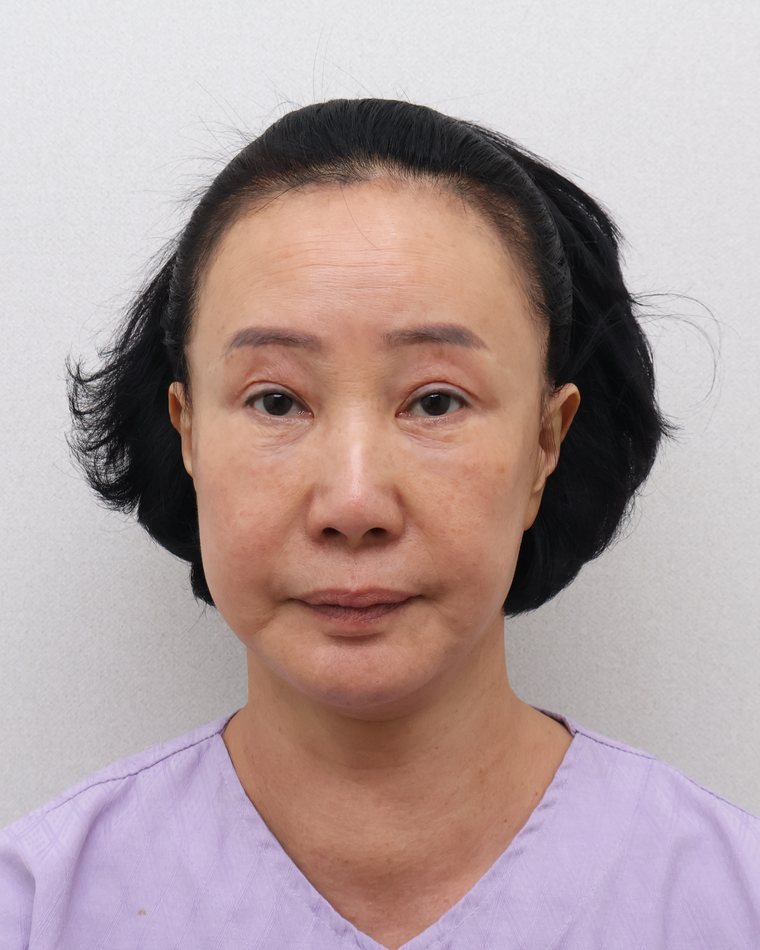 Facelift — after treatment