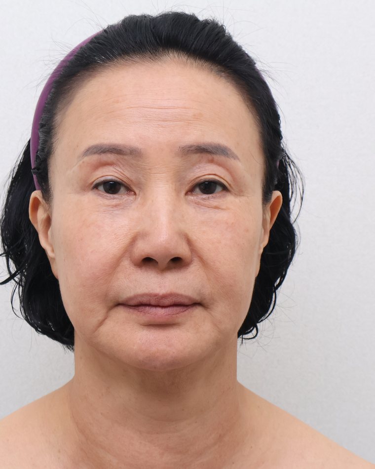 Facelift — before treatment