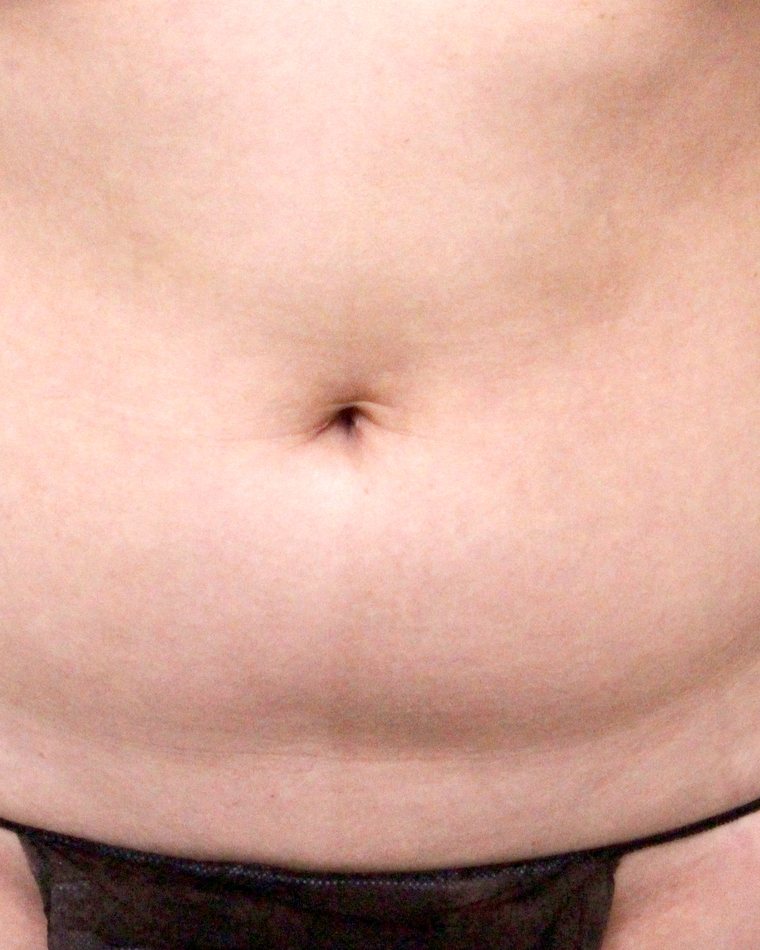 Liposuction — before treatment